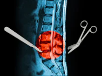 Medizin: Rückenschmerzen – operieren oder nicht?