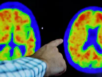 Medizin: Hoffnung und Sorge um neues Alzheimer-Medikament