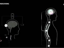 : Neuralink verkündet Zulassung für Studie am Menschen